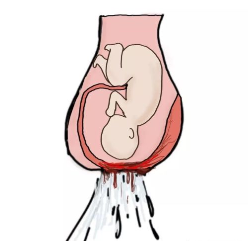 产科医生笔记之产前出血最危险因素——前置血管