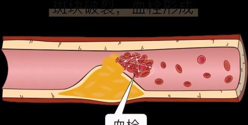 血栓“分解器”被发现，洋葱排尾，医生：敞开吃，降胆固醇和血脂