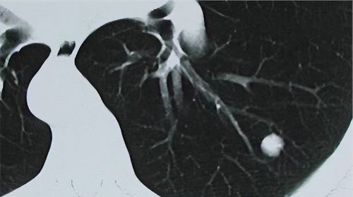 发现肺结节，如何初步判断是良性还是恶性