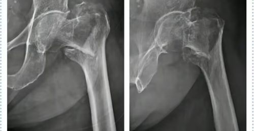 养骨就是养寿！骨科医生提醒：50岁后，4个养骨诀窍要牢记！