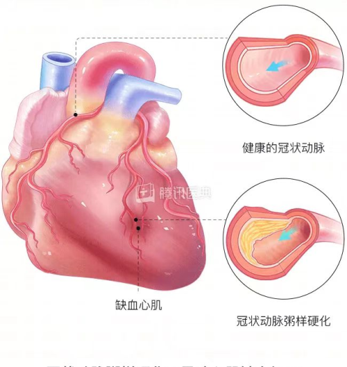 男子胸闷误以为新冠后遗症，医生：再晚来一步，神仙都难保……