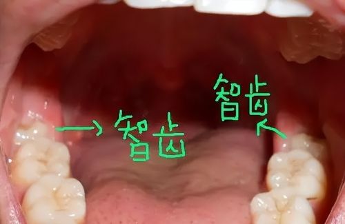 人体有6个器官可以“拿掉”，不会影响正常生活，是不是真的？