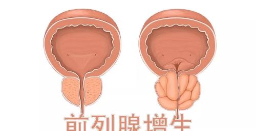 年纪大了，“晚上起夜”与“不起夜”，哪个更健康？医生说出实情