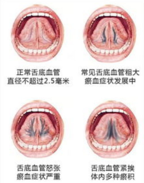 舌下青筋又粗又黑，教你一招打通脉络