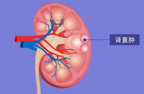 一文看懂肾囊肿是怎么回事