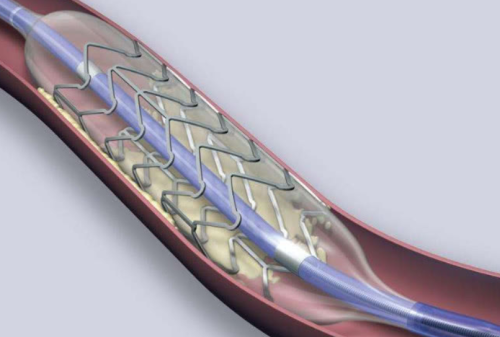 心脏支架手术到底是治病救人还是缺德害人？医生一文告诉您答案