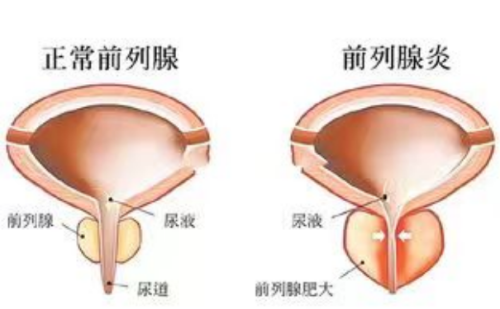 慢性前列腺患者还在这么做？中医给你几点忠告