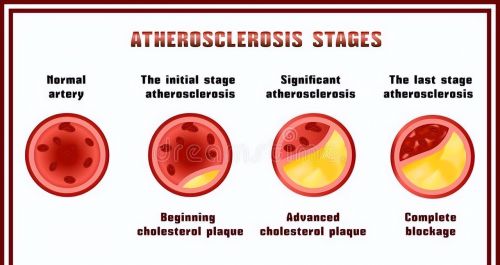 颈动脉斑块，60岁以上几乎全有，严重可致中风！学会这4招来应对