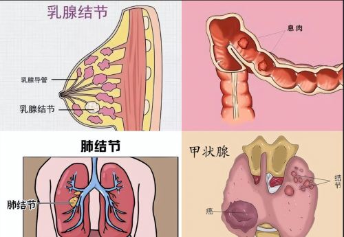 身体多种结节，用一个方子效果翻三倍