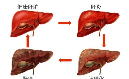 夫妻二人相继确诊肝癌？医生苦劝：2味“调料”，怎能天天吃？