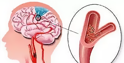 有几类人容易患脑梗、脑出血？
