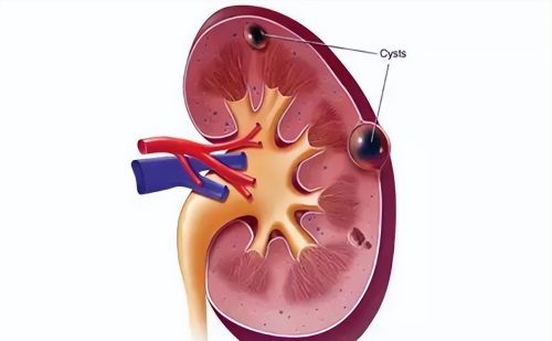 查出肾囊肿，危险吗？需要治疗吗？