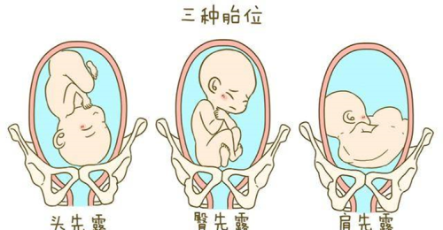 头先露、臀先露、肩先露…哪些胎位可以自己生？胎位异常怎么办？