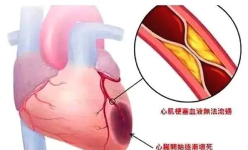 做好医生的ABCDE，冠心病患者不再为心肌梗死犯愁