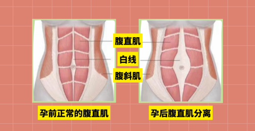 一眼就能看出是否生过娃？五张图告诉你，为啥怀孕后身材会走样