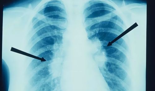 检查身体时，发现肺结节该怎么办？平时注意4点，或有助病情恢复