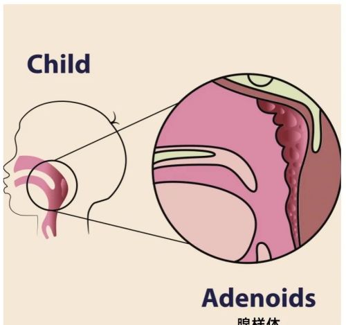 巧用消腺汤！鼻塞，打呼，张嘴呼吸！扁桃体腺样体都能用！