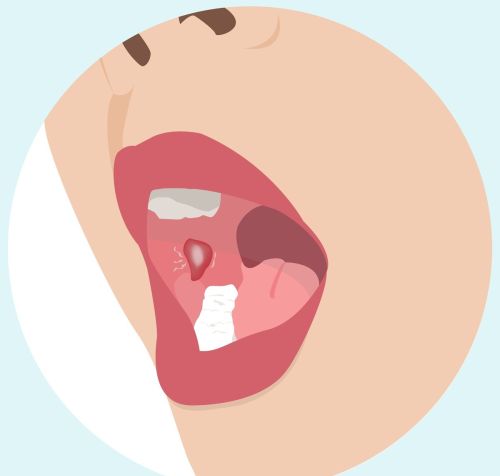 体内有癌，嘴巴先知？口腔内的3种迹象，可能是癌症来敲门