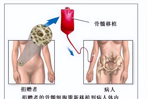 再生障碍性贫血，除了造血干细胞移植，还有这些治法！