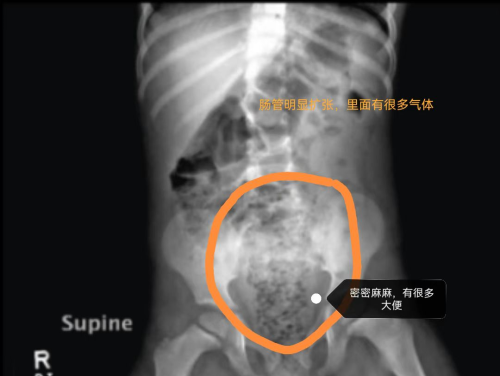 3岁宝宝出现肠梗阻，原因竟是偷吃了一包瓜子