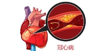 该如何护理冠心病患者？