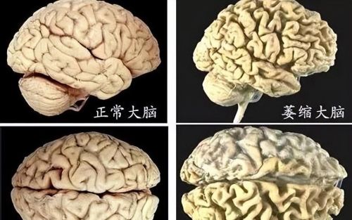 大脑开始“萎缩”，身体一般会出现3个反应，要提前预防