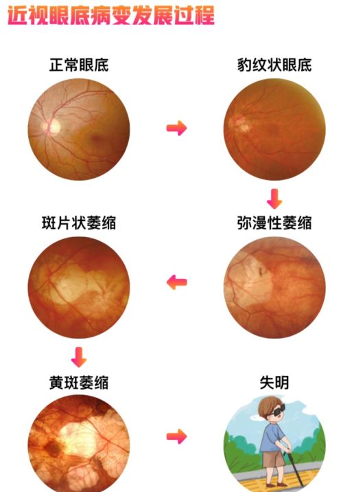 超高度近视阿姨遭遇“网裂”，医生：别让心灵的窗户“破洞”