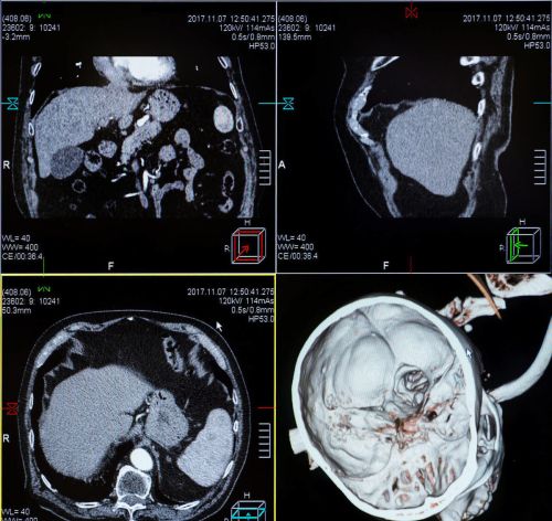 做一次CT，对身体有危害？致癌吗？医生建议：做好4点降低伤害