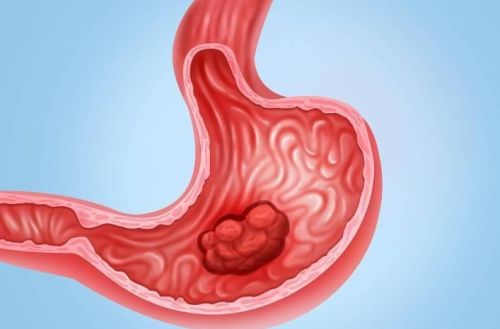 胃溃疡和胃癌之间有关联吗？查出胃癌必须开刀吗？6种方案可选