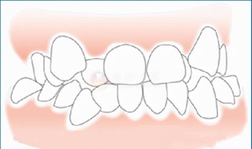 常见的几种牙齿不齐(牙齿不齐的几种类型)