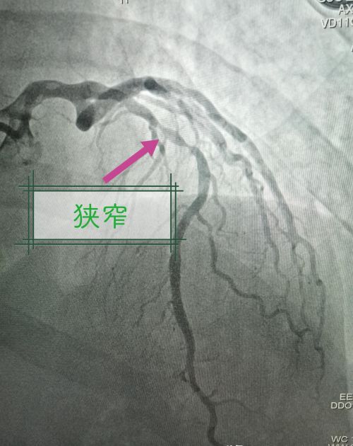 治疗心衰的方法有哪些？