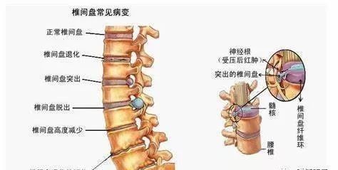 吊单杠能不能缓解腰间盘突出呢？