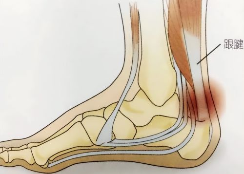 经常脚后跟痛？不要觉得忍忍就好！医生：可能和3种病有关