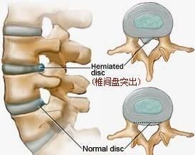 有什么运动能帮助恢复腰椎盘突出？