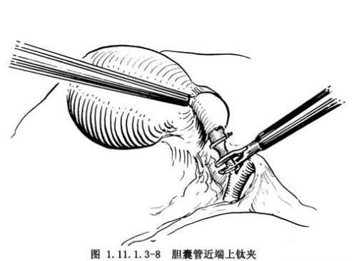 有什么治疗胆囊结石的方法推荐？