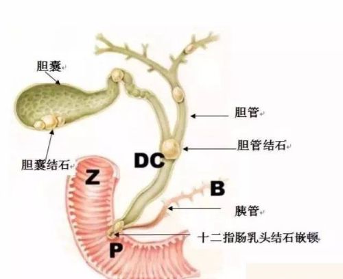 有什么治疗胆囊结石的方法推荐？