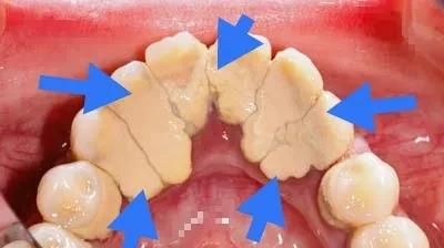 牙结石是如何形成的？洗了牙之后要怎么做才能防止再长牙结石？