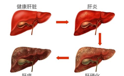 肝炎会变成肝癌吗？