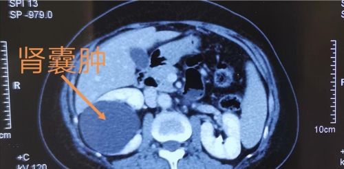 做增强CT，发现右肾小囊肿，会变成癌症吗？