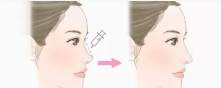 鼻部整形中隆鼻和鼻综合整形具体有什么区别？