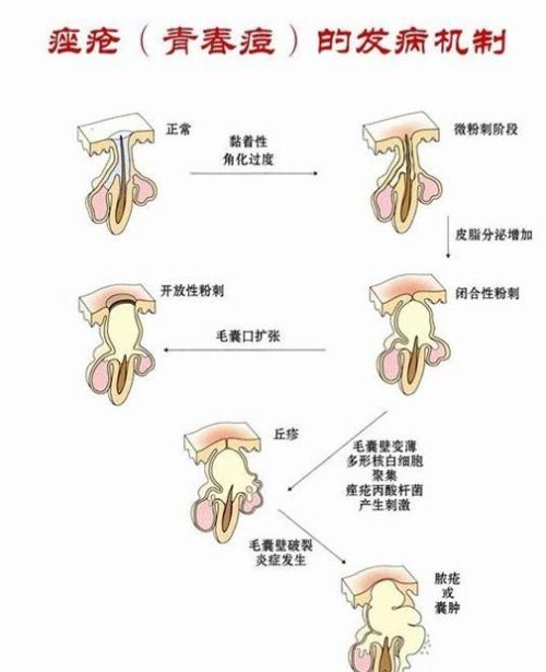 脸上不同部位长痘，代表对应的五脏六腑有问题吗？