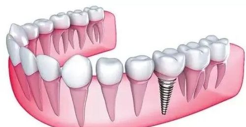 种植牙有哪些坑？
