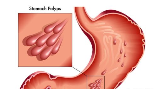胃息肉是怎么生成的？