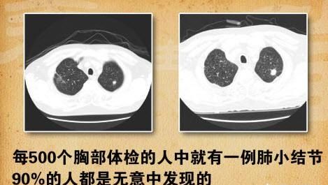 肺叶有结节是什么意思？