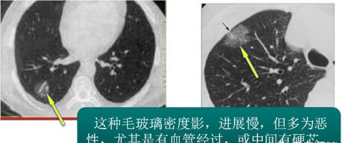 肺叶有结节是什么意思？