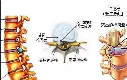 哪位高人有治颈椎病的偏方？