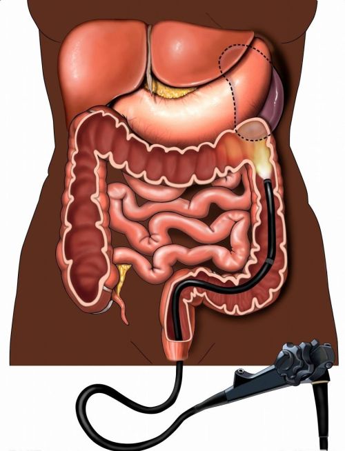 最近肠胃不太好，请问做过肠胃镜的朋友，是做肠镜痛苦还是胃镜痛苦？