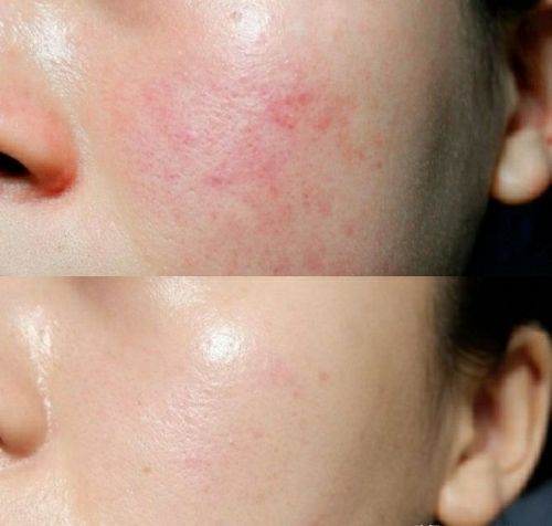 22岁，皮肤屏障受损了之后，脸颊特别容易泛红，网上推荐的护肤品又很贵，怎么在不花许多钱的基础上修复呢？