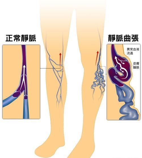 50岁男子小腿上盘踞的血管像“小蚯蚓”一样，是什么病？