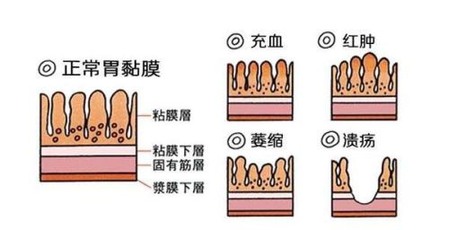 慢性胃炎为何久治不愈，什么原因？